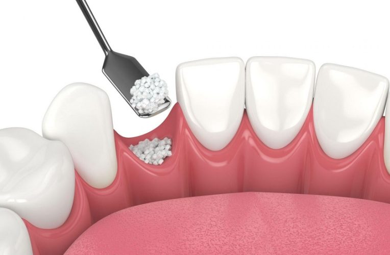 Ghép xương hỗ trợ phục hình răng Implant