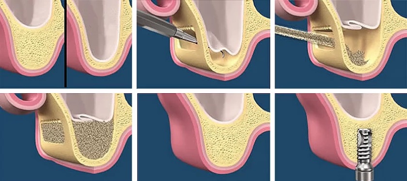Nâng xoang hỗ trợ phục hình răng Implant