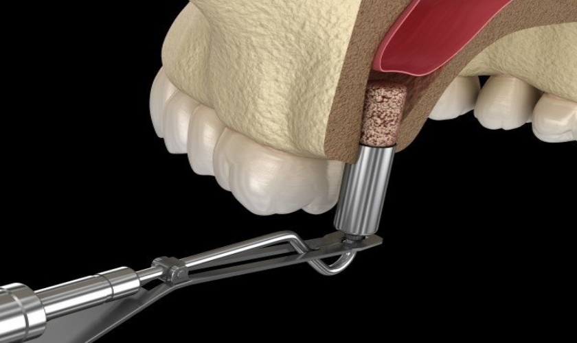 Nâng xoang kín là kỹ thuật hỗ trợ đắc lực cho quá trình cấy ghép implant