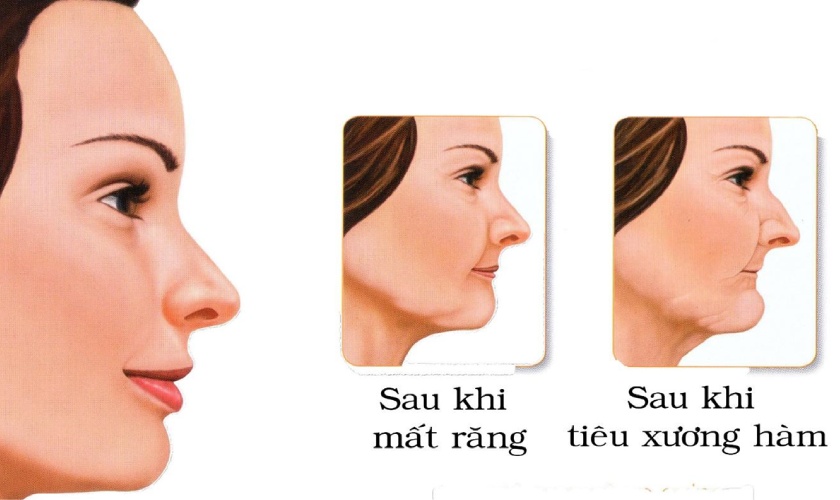 Thời gian cấy ghép xương tuỳ thuộc vào tình trạng của từng khách hàng