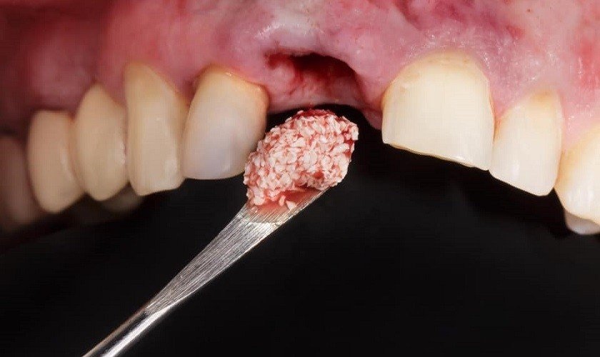 Quy trình cấy ghép xương tại Implant Center được các bác sĩ thực hiện rất tỉ mỉ