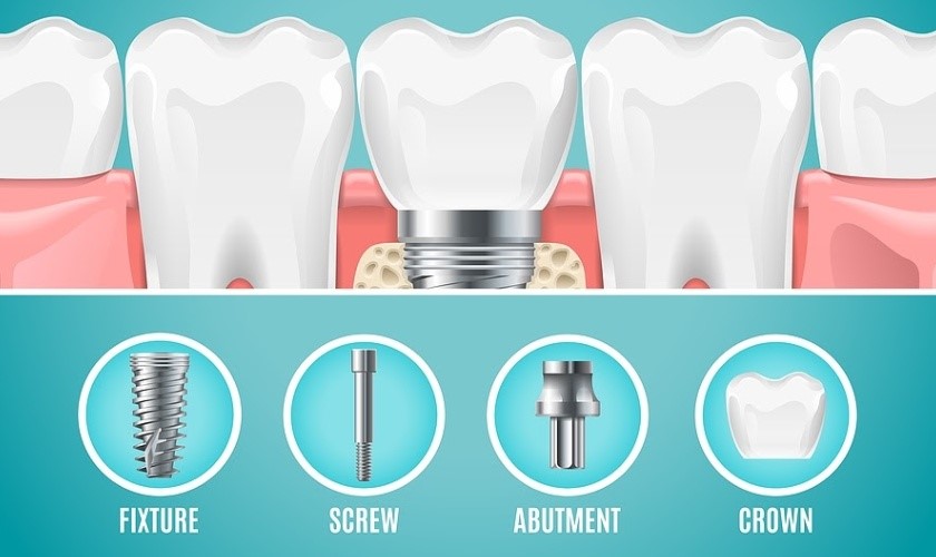 Implant Center chỉ sử dụng các vật liệu cấy ghép chất lượng cao