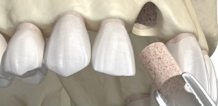 Ghép thêm xương trước khi đặt trụ Implant trong trường hợp xương đã bị tiêu nhiều