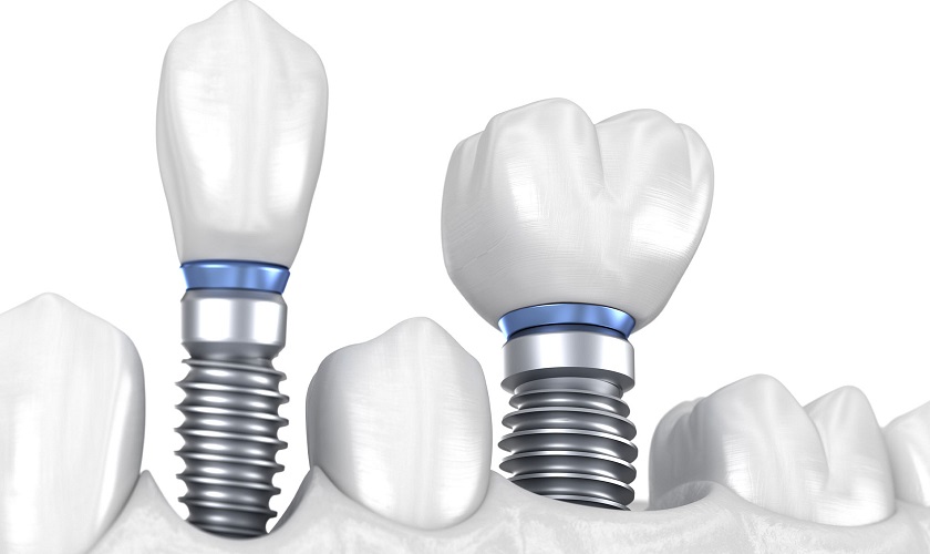 Nhật ký trồng răng Implant – 4 kinh nghiệm cần biết
