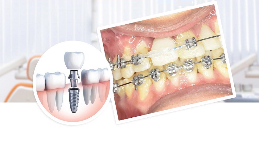 [Tư vấn] Có thể niềng răng Implant được không?