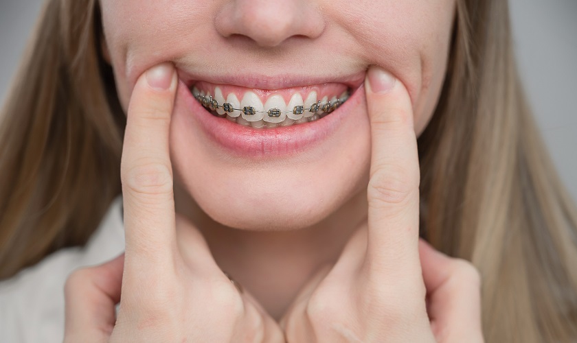 Thông thường khách hàng nên thực hiện niềng răng trước khi cấy ghép Implant