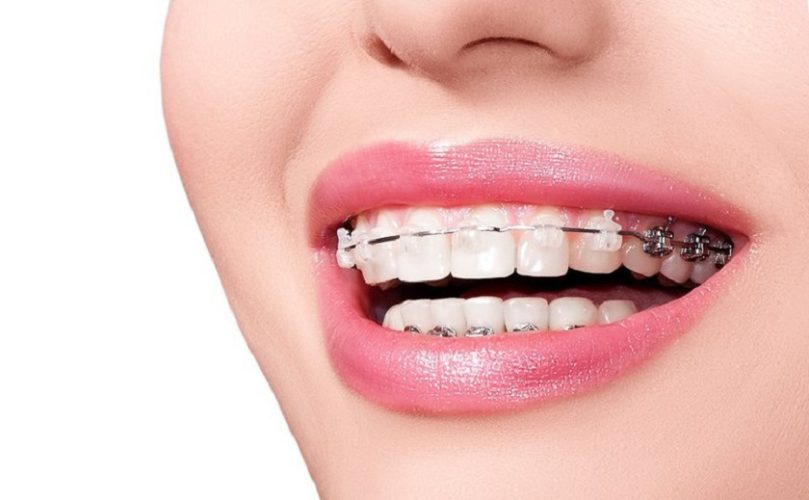 Niềng răng Implant