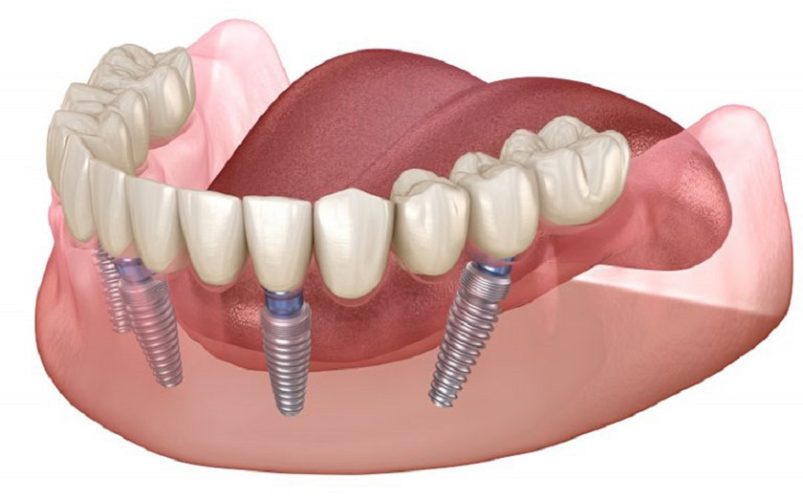 Nếu đã cấy ghép Implant toàn hàm bạn sẽ không thể và cũng không cần thiết phải niềng răng nữa