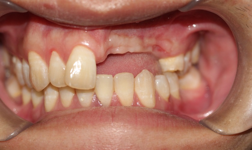 Trồng 3 răng liên tiếp nên chọn phương pháp nào?