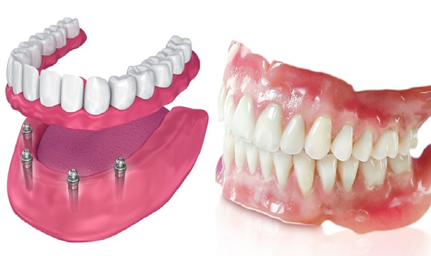 2 phương pháp trồng răng giả nguyên hàm hiện nay