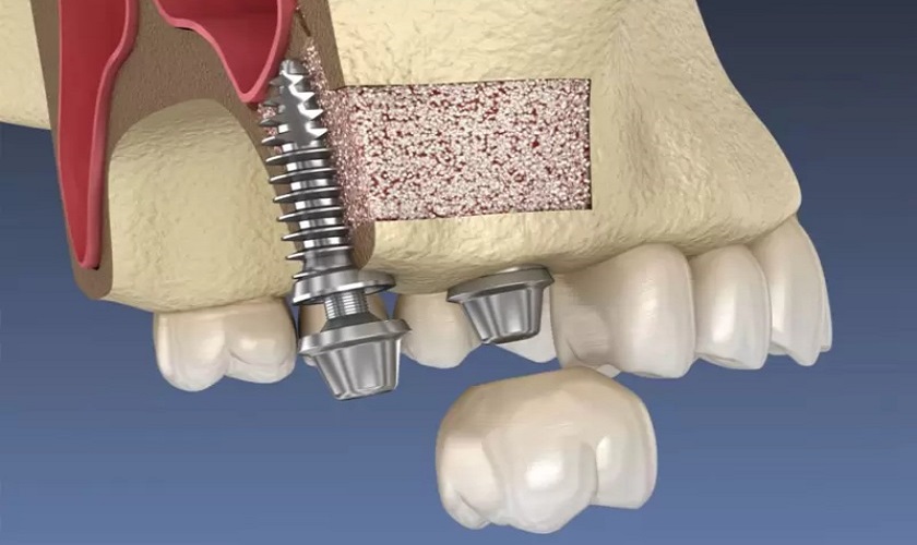 Ứng dụng công nghệ PRP trong cấy ghép Implant