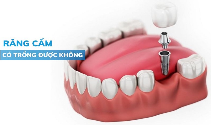 Răng cấm có trồng được không? Phương pháp nào phù hợp?