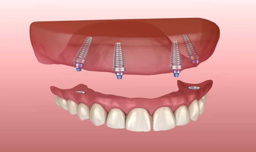 Chi tiết về răng giả tháo lắp trên Implant