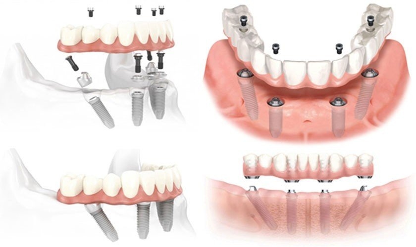 Răng giả tháo lắp trên Implant