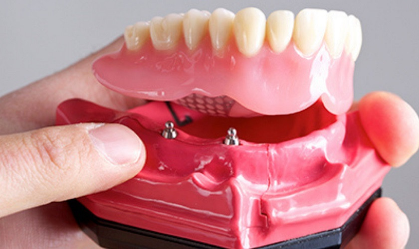 Răng giả tháo lắp trên Implant không có thanh bar