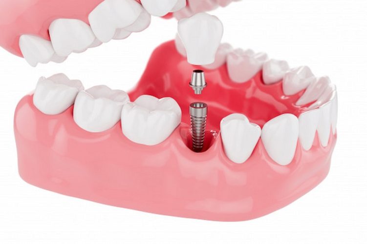 Cấy ghép Implant – Kỹ thuật phục hình tối ưu của nha khoa hiện đại