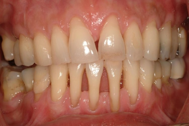 Viêm nha chu là nguyên nhân chủ yếu khiến răng bị lung lay