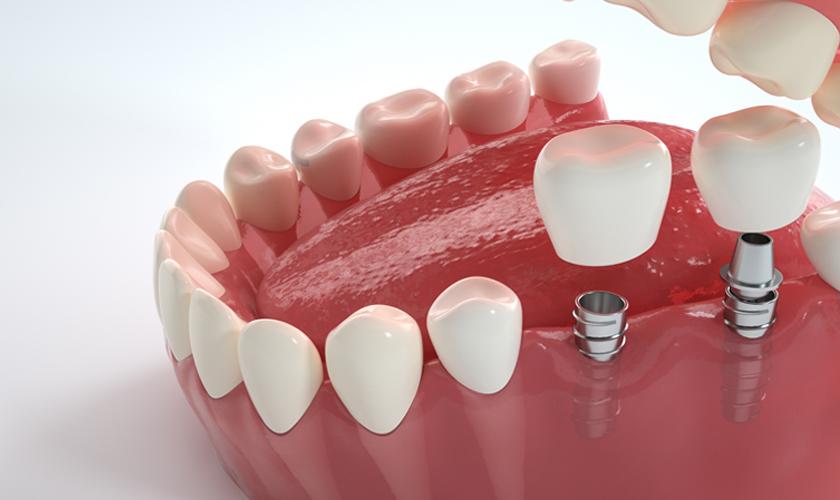 Răng sứ trên Implant có thay mới được không?
