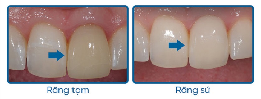 Sự khác biệt giữa răng tạm trên Implant và răng sứ cố định