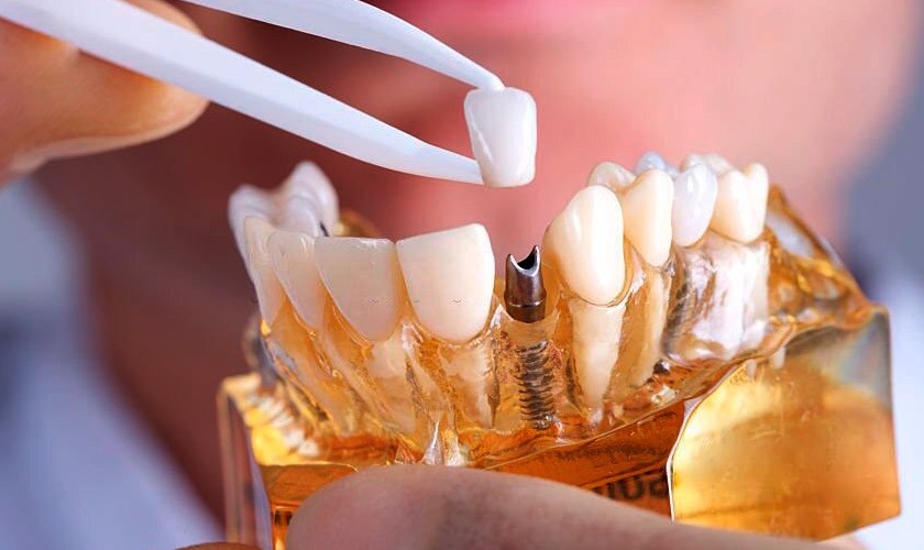 Răng tạm trên Implant mang lại nhiều lợi ích cho người dùng