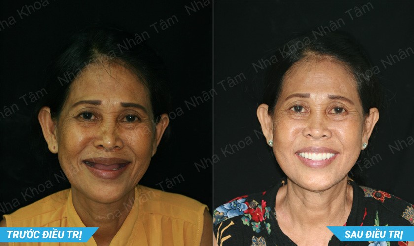 Hình ảnh khách hàng Ngọc Linh trước và sau điều trị