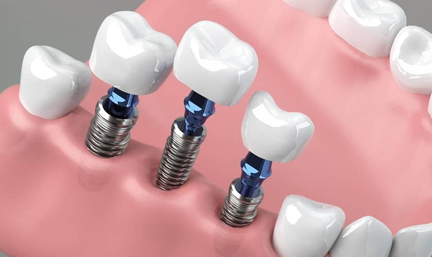 Sau khi cấy ghép Implant có cần uống thuốc không?