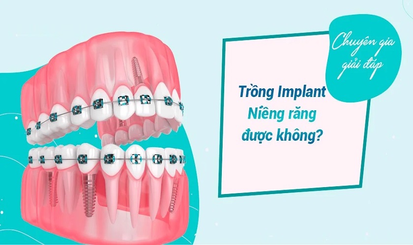 Sau khi trồng Implant có niềng được không?