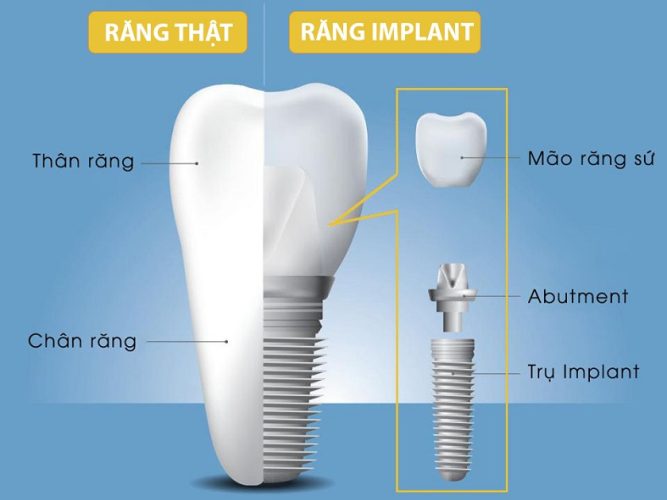 Răng Implant sau cấy ghép có cấu trúc tương tự với răng thật