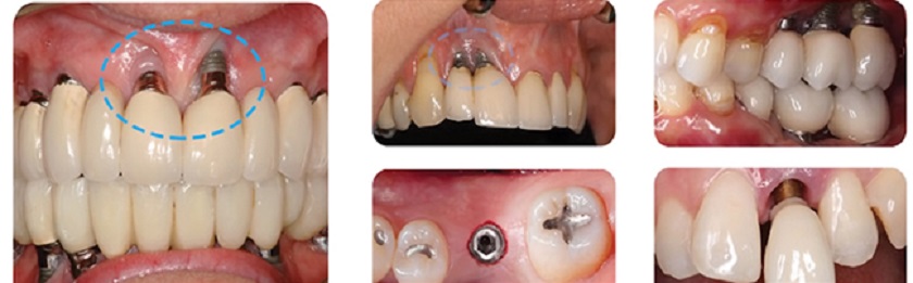 Lộ trụ Implant gây mất thẩm mỹ do tiêu xương tại khu vực cổ trụ