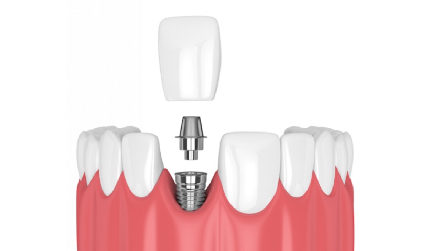 Phương pháp tái tạo răng mất bằng cấy ghép Implant