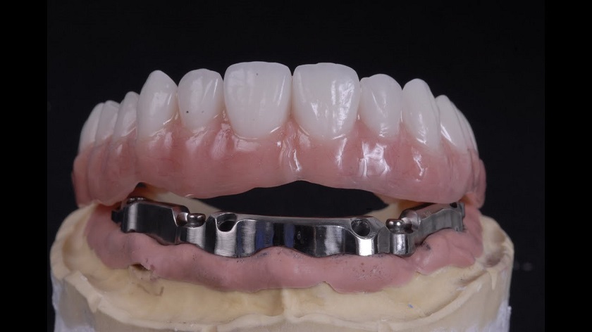 Hàm tháo lắp có thanh bar trong trồng răng Implant All on X