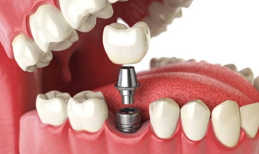 5 trường hợp cần tháo Implant thất bại và trồng răng mới
