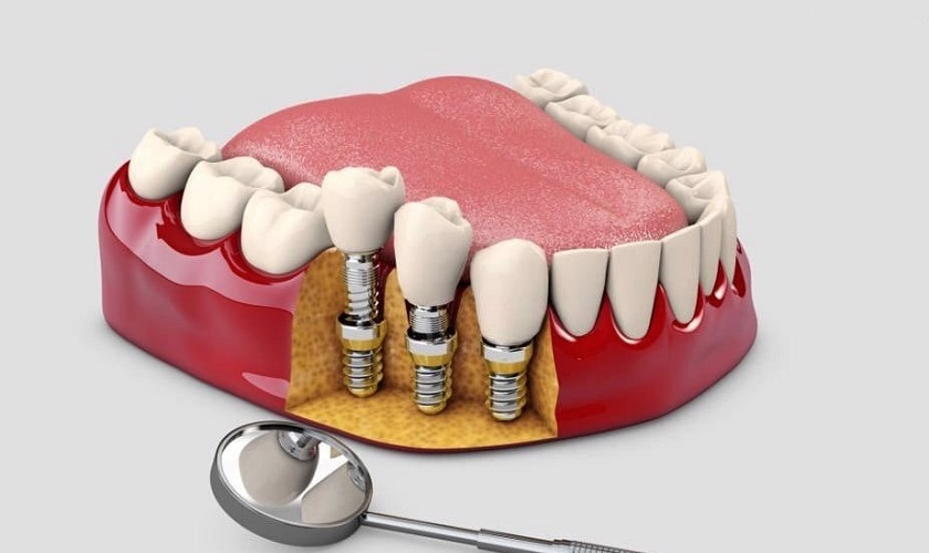 Trồng răng lâu không và một số yếu tố ảnh hưởng