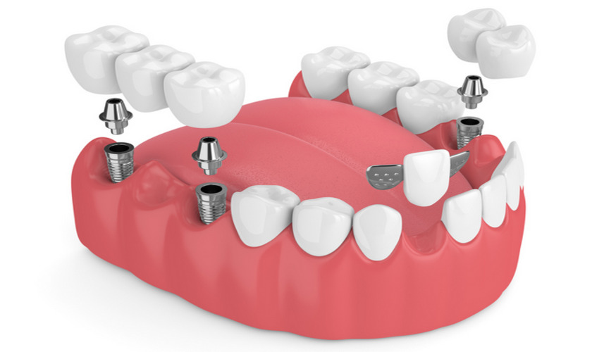 Thương hiệu trụ Implant ảnh hưởng đến kết quả phẫu thuật như thế nào?