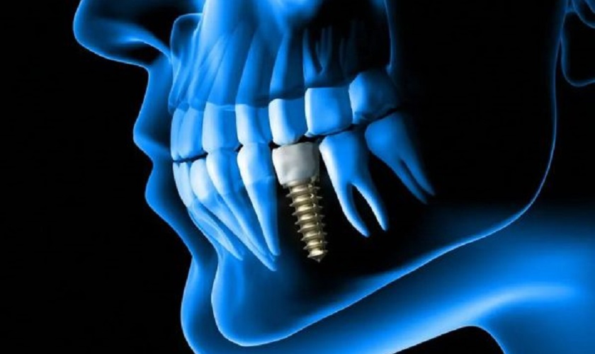 Tiêu chuẩn xương hàm khi trồng răng Implant cần đáp ứng