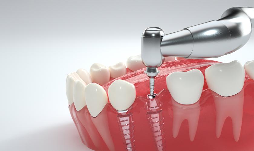 Cấy ghép Implant - Biện pháp khắc phục tiêu xương hàm ở người cao tuổi hiệu quả