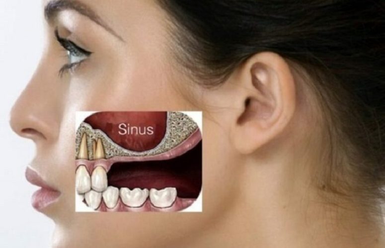 Xoang hàm hạ thấp và mở rộng do tiêu xương hàm trên