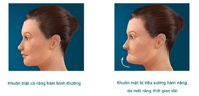 Sự biến đổi gương mặt sau khi bị tiêu xương