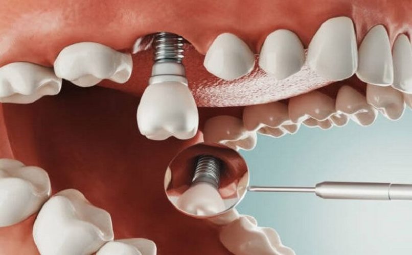 Cấy ghép Implant giúp ngăn chặn sự tiêu hủy xương hàm