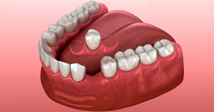 Sử dụng răng giả tạm thời cho trẻ em