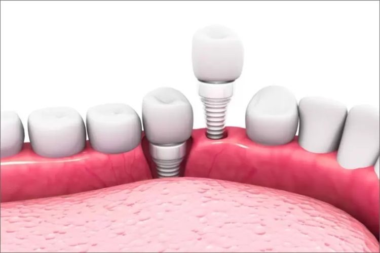 Trồng chân răng bằng cấy ghép Implant