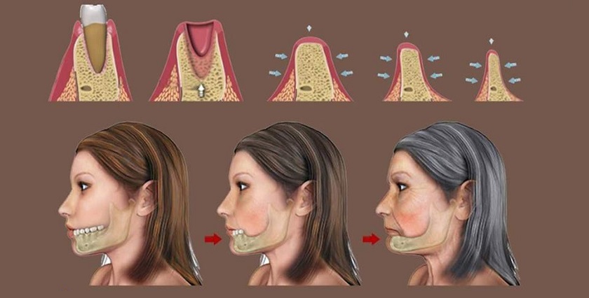 Nếu không được khôi phục chân răng, xương hàm sẽ ngày càng tiêu biến nhiều