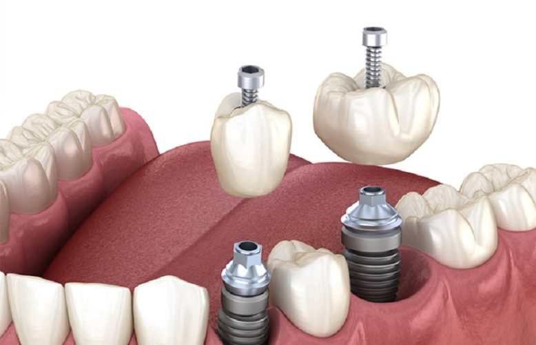 Trồng răng Implant