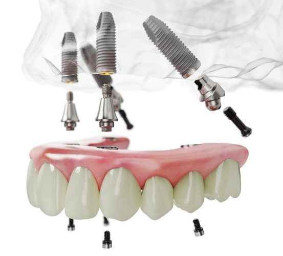 Trồng răng Implant All on 4