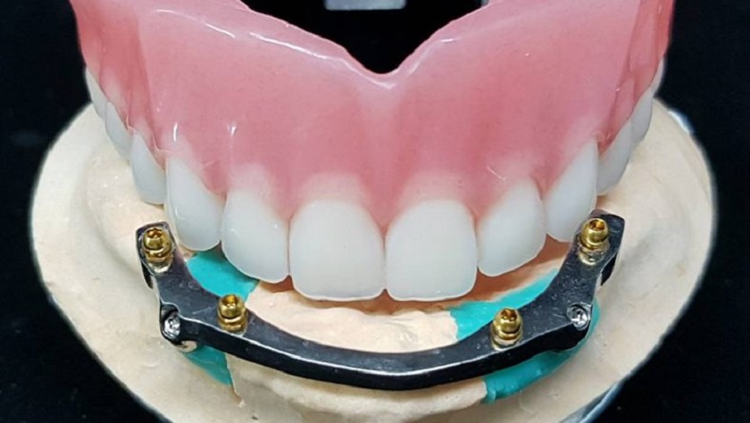 Các trụ chân răng trong kỹ thuật Implant All on 4 được liên kết chắc chắn qua thanh bar