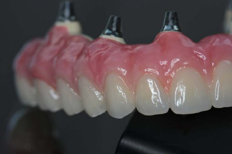 Hàm giả được chế tác từ vật liệu sinh học BioHPP tại Implant Center