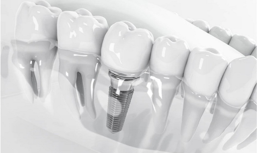 Tìm hiểu về trồng răng Implant bắt vít và xi măng