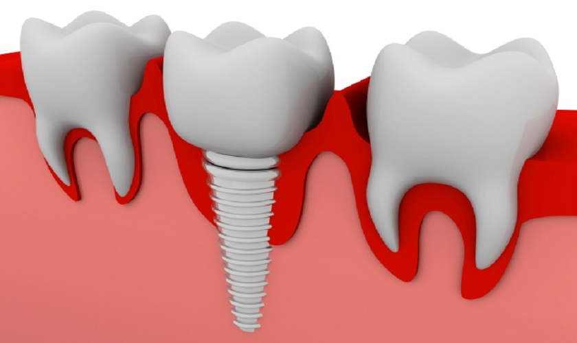 Trồng răng Implant bị chảy máu – Nguyên nhân và cách xử lý