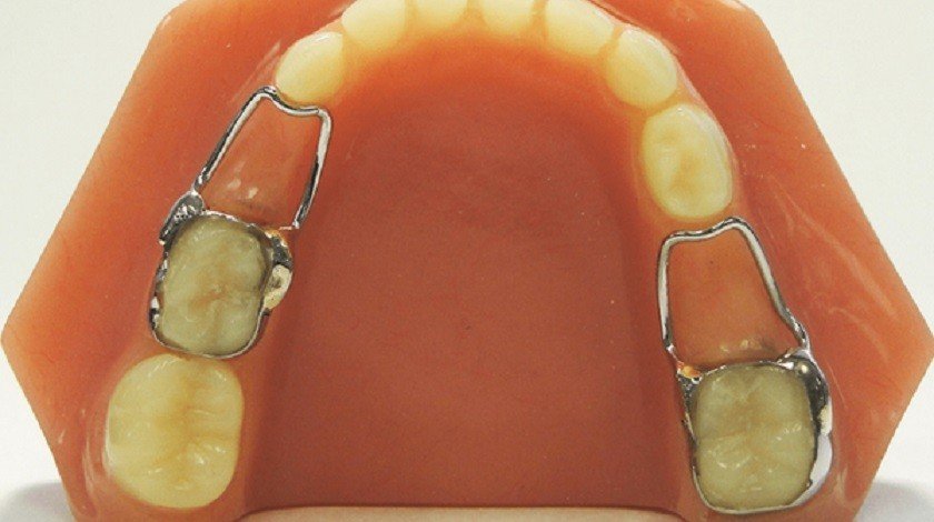 Nên sử dụng hàm giữ khoảng cho trẻ cho đến khi đủ điều kiện trồng răng Implant