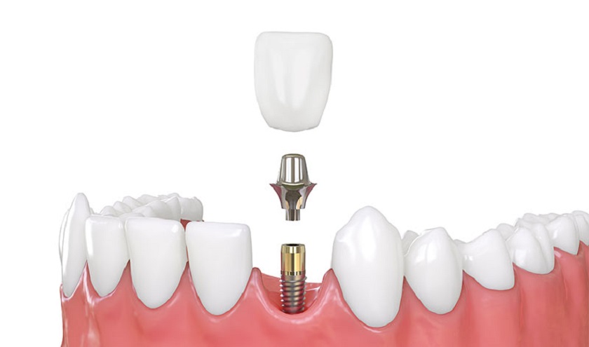 Trồng răng Implant có an toàn không?